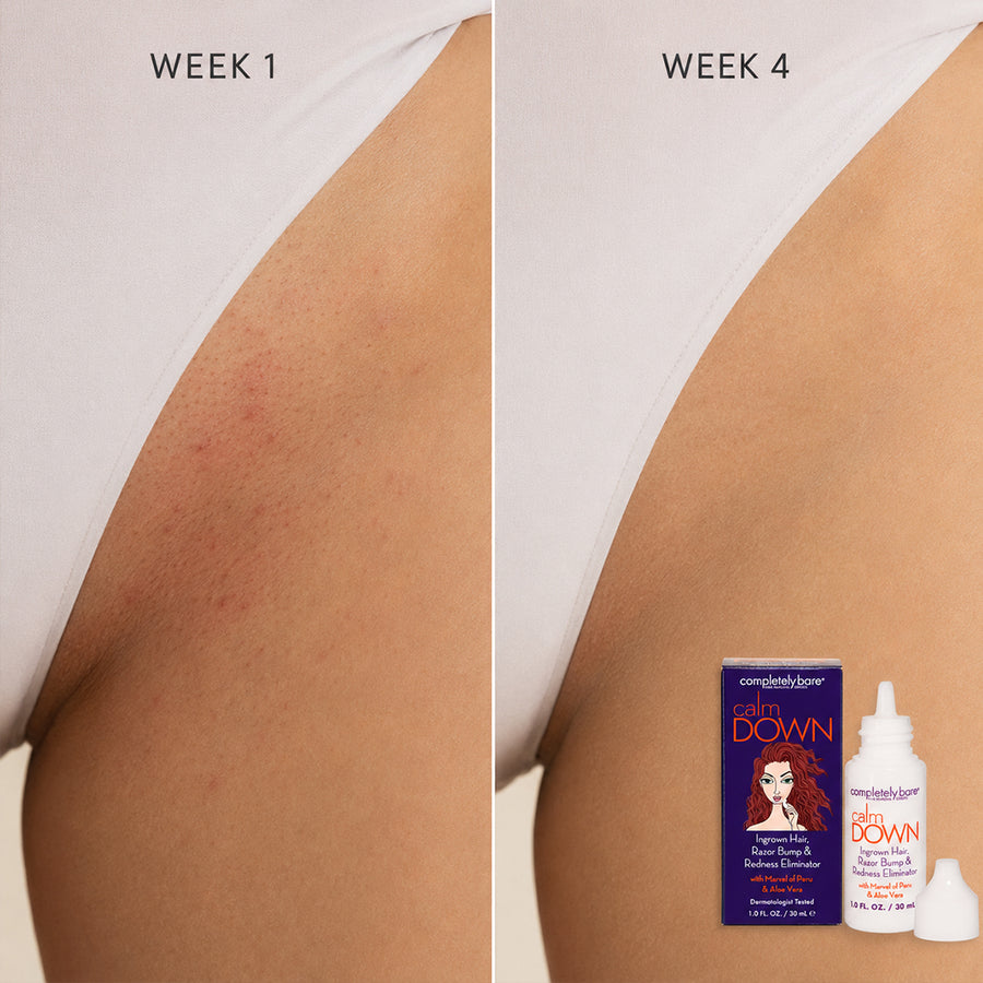 calm DOWN Ingrown Hair, Razor Bump & Redness Eliminator