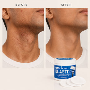 razor bump BLASTER Ingrown Hair & Razor Bump Eliminator for Men
