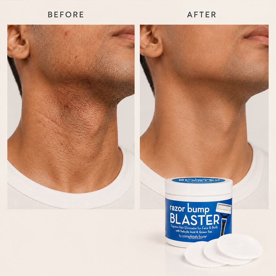 razor bump BLASTER Ingrown Hair & Razor Bump Eliminator for Men