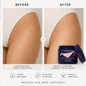 bikini bump BLASTER Ingrown Hair & Bikini Bump Eliminator
