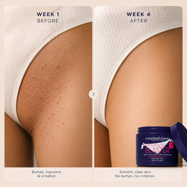 bikini bump BLASTER Ingrown Hair & Bikini Bump Eliminator