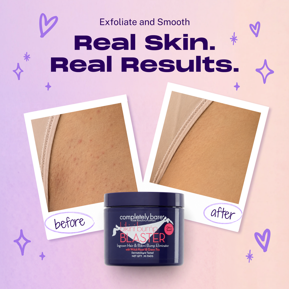 bikini bump BLASTER Ingrown Hair & Bikini Bump Eliminator